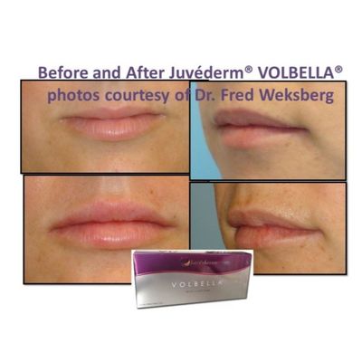 Hyaluronic Acid Juvederm Face Filler Gel da mịn màng và hoàn hảo