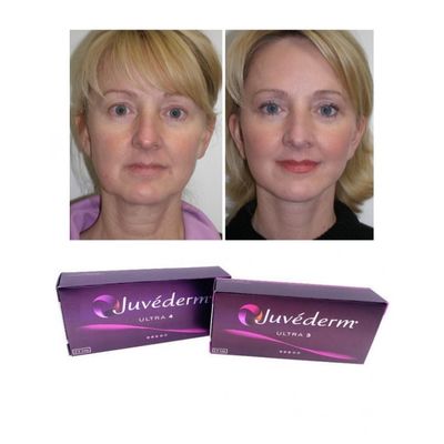 6-9 tháng Thời gian sử dụng Juvederm Dermal Filler Gel Cho mua trực tuyến và trong cửa hàng