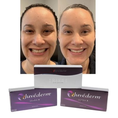 Juvederm Dermal Lip Fillers Hyaluronic Acid Cross Linked Injection Tiêm