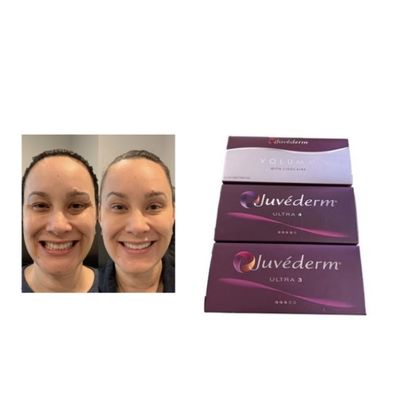Chất làm đầy da Juvederm HA liên kết chéo Ultra3 Ultra4 Voluma Điều kiện bảo quản Tránh đông lạnh Gel tiêm để phục hồi thể tích khuôn mặt