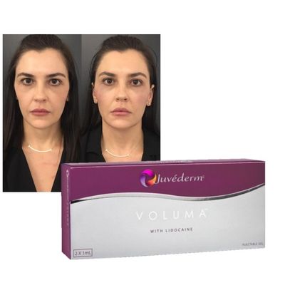 Hyaluronic Acid Dermal Filler Gel Juvederm môi má cải thiện công thức trẻ hóa