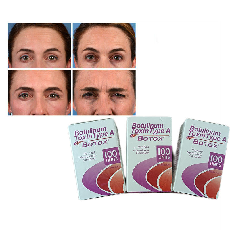 100U/ lọ Botulinum Toxin loại A  bột chống nếp nhăn