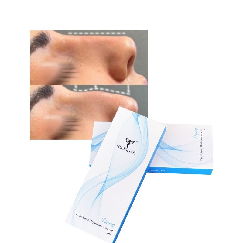 Liên kết chéo 2ml Hyaluronic Acid Dermal Filler Deep Line Mũi Contour Gel tiêm nâng cơ mặt